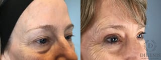 Before and after Eye Lid Surgery case 43348 - Angle 3