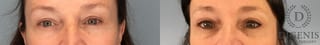 Before and after Eye Lid Surgery case 43361 - Angle 1