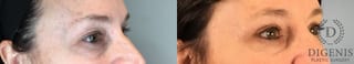 Before and after Eye Lid Surgery case 43361 - Angle 2