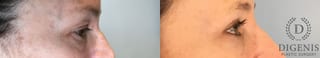 Before and after Eye Lid Surgery case 43361 - Angle 3
