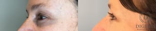 Before and after Eye Lid Surgery case 43361 - Angle 4