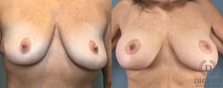 Before and after Breast Augmentation case 43362 - Angle 1