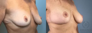 Before and after Breast Augmentation case 43362 - Angle 2
