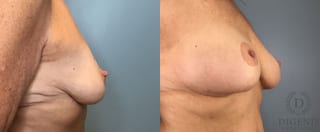Before and after Breast Augmentation case 43362 - Angle 3