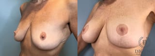 Before and after Breast Augmentation case 43362 - Angle 4