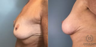 Before and after Breast Augmentation case 43362 - Angle 5