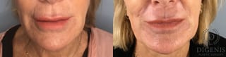 Before and after Laser Skin Resurfacing case 43368 - Angle 1