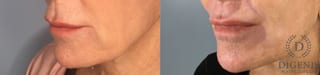 Before and after Laser Skin Resurfacing case 43368 - Angle 2