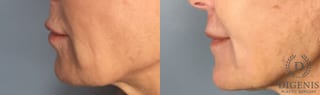 Before and after Laser Skin Resurfacing case 43368 - Angle 3