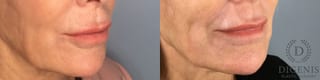 Before and after Laser Skin Resurfacing case 43368 - Angle 4