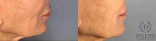 Before and after Laser Skin Resurfacing case 43368 - Angle 5