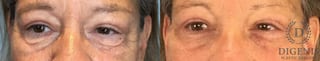 Before and after Eye Lid Surgery case 41927 - Angle 1