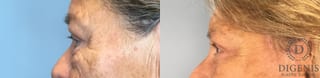 Before and after Eye Lid Surgery case 41927 - Angle 2
