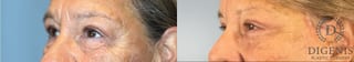 Before and after Eye Lid Surgery case 41927 - Angle 3