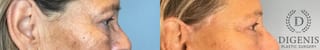 Before and after Eye Lid Surgery case 41927 - Angle 4
