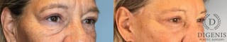 Before and after Eye Lid Surgery case 41927 - Angle 5