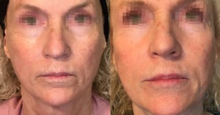 Before and after Laser Skin Resurfacing case 35162 - Angle 1