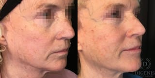 Before and after Laser Skin Resurfacing case 35162 - Angle 2