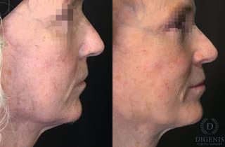 Before and after Laser Skin Resurfacing case 35162 - Angle 3