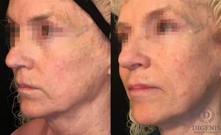 Before and after Laser Skin Resurfacing case 35162 - Angle 4