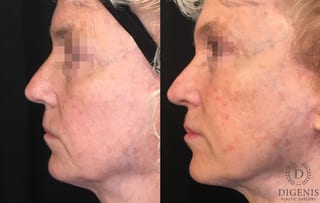 Before and after Laser Skin Resurfacing case 35162 - Angle 5