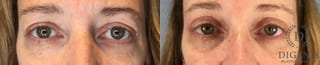 Before and after Eye Lid Surgery case 43430 - Angle 1