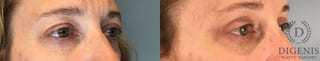 Before and after Eye Lid Surgery case 43430 - Angle 2