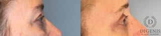 Before and after Eye Lid Surgery case 43430 - Angle 3