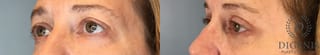 Before and after Eye Lid Surgery case 43430 - Angle 4