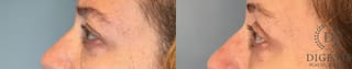 Before and after Eye Lid Surgery case 43430 - Angle 5