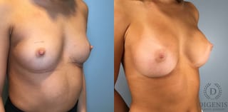 Before and after Breast Augmentation case 43431 - Angle 2