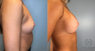 Before and after Breast Augmentation case 43431 - Angle 3