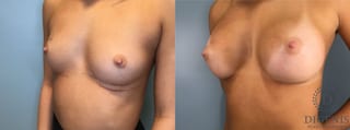 Before and after Breast Augmentation case 43431 - Angle 4