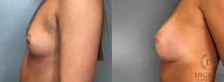 Before and after Breast Augmentation case 43431 - Angle 5