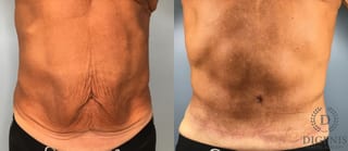 Before and after Tummy Tuck case 43448 - Angle 1