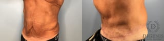 Before and after Tummy Tuck case 43448 - Angle 2