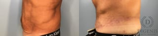 Before and after Tummy Tuck case 43448 - Angle 3