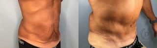 Before and after Tummy Tuck case 43448 - Angle 4