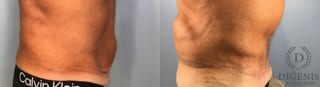 Before and after Tummy Tuck case 43448 - Angle 5