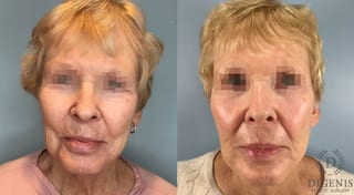 Before and after Temple Lift case 43450 - Angle 1