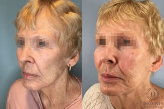 Before and after Temple Lift case 43450 - Angle 2