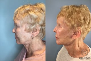 Before and after Temple Lift case 43450 - Angle 3