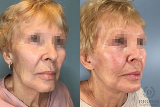 Before and after Temple Lift case 43450 - Angle 4