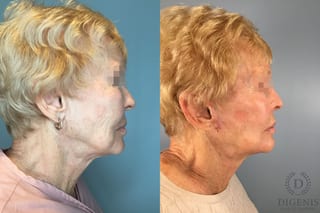 Before and after Temple Lift case 43450 - Angle 5