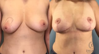 Before and after Breast Lift with or without Implants case 43491 - Angle 1