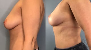 Before and after Breast Lift with or without Implants case 43491 - Angle 2