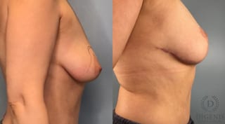 Before and after Breast Lift with or without Implants case 43491 - Angle 3