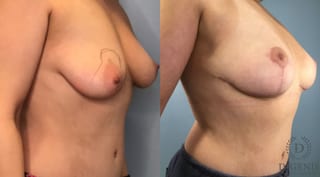 Before and after Breast Lift with or without Implants case 43491 - Angle 4