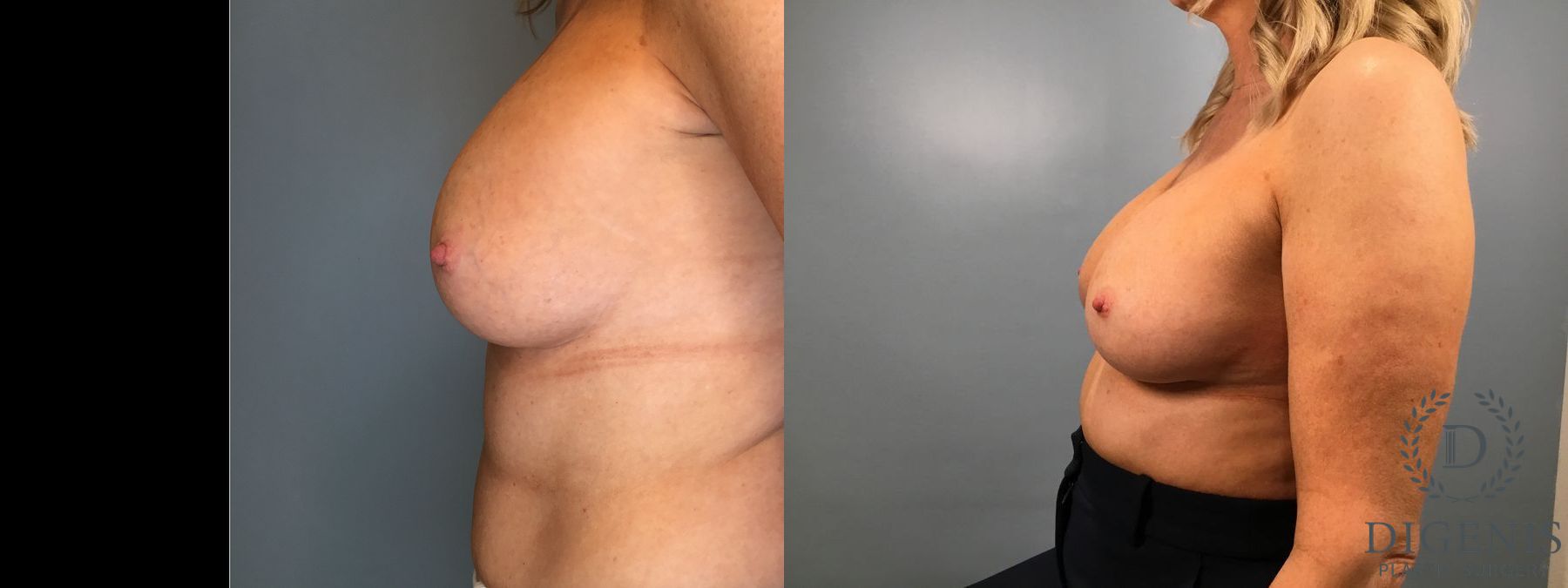 Before and after Breast Implant Exchange or Removal case 41360 - Angle 3