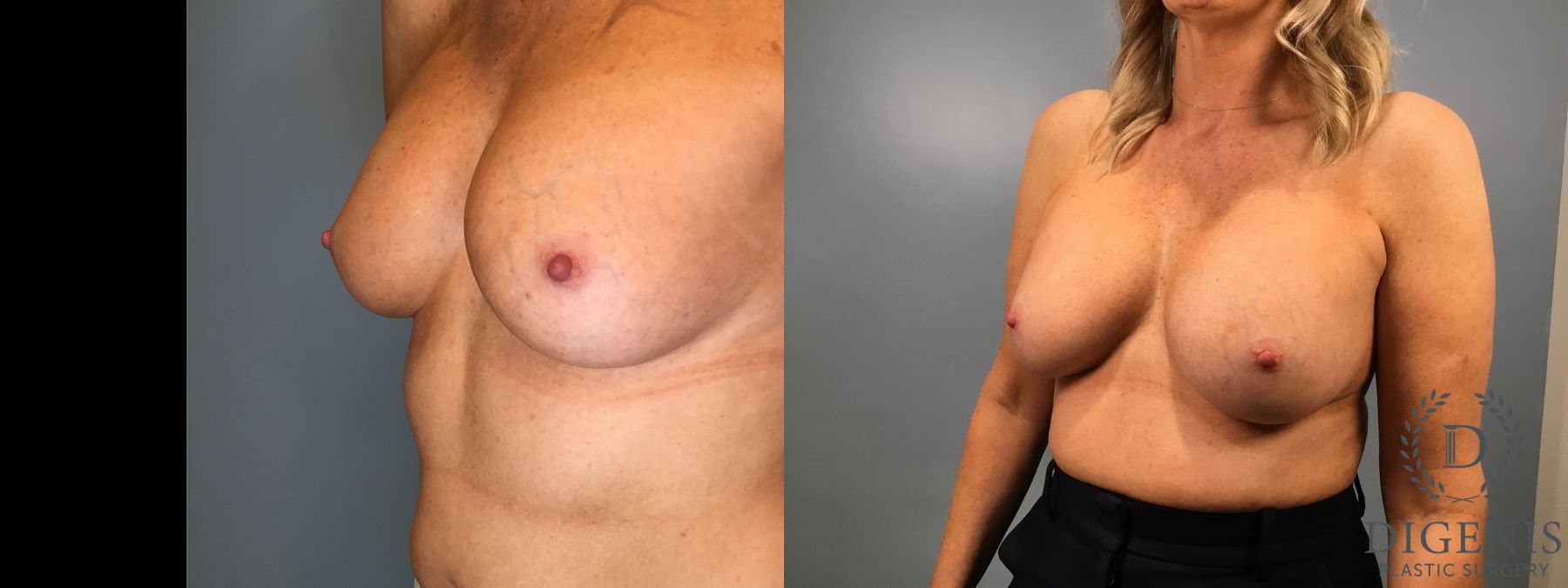 Before and after Breast Implant Exchange or Removal case 41360 - Angle 2